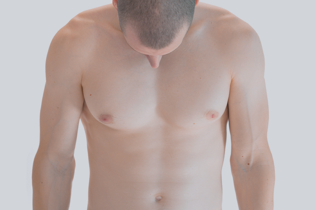 Cure de gynécomastie aux Sables d'Olonne