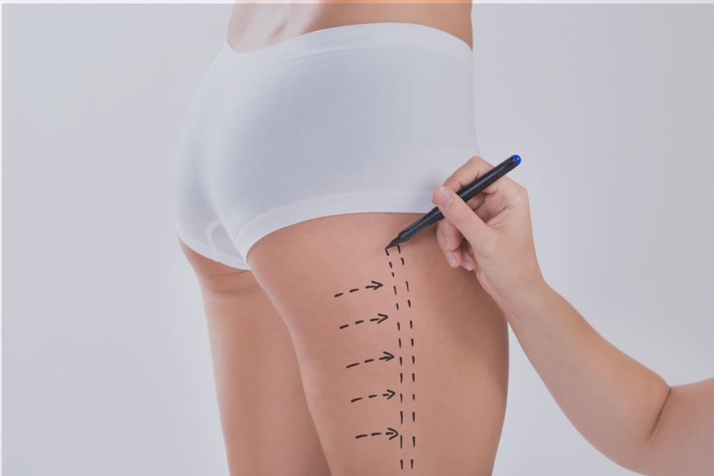 Cruroplastie ou lifting des cuisses aux Sables d'Olonne