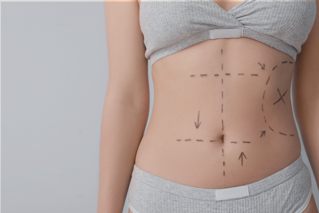 Abdominoplastie aux Sables d'Olonne