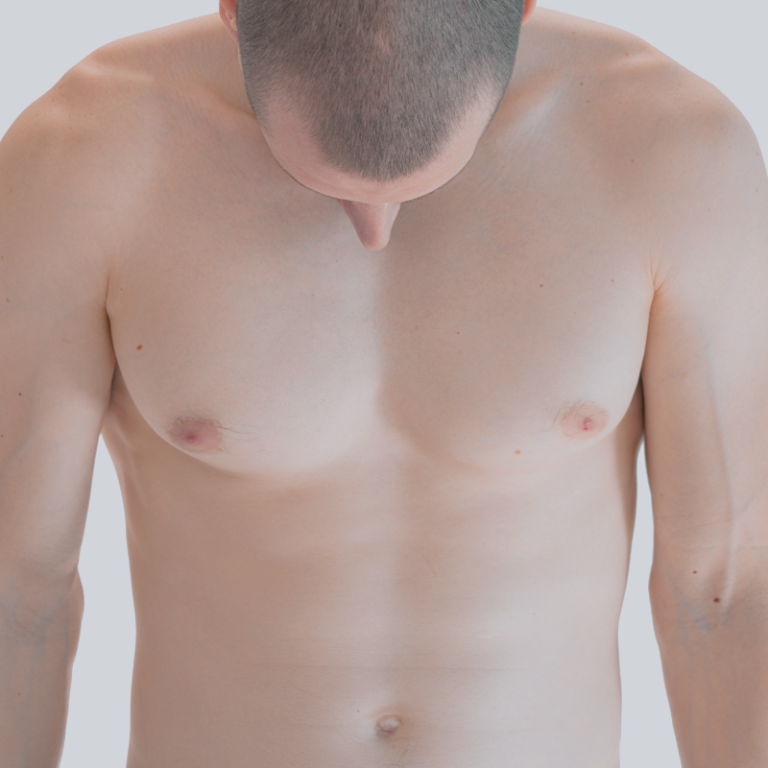 Cure de gynécomastie aux Sables d'Olonne