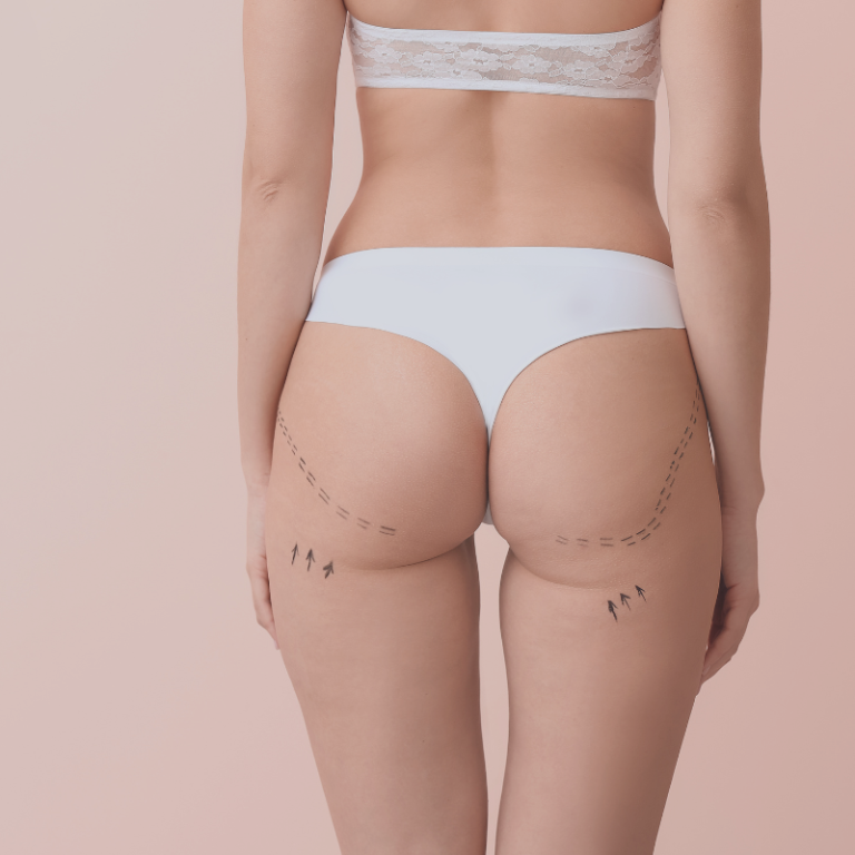 Lipoaspiration ou liposuccion aux Sables d'Olonne