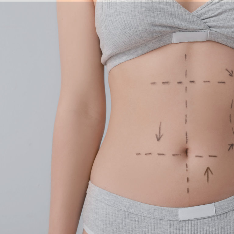 Abdominoplastie aux Sables d'Olonne