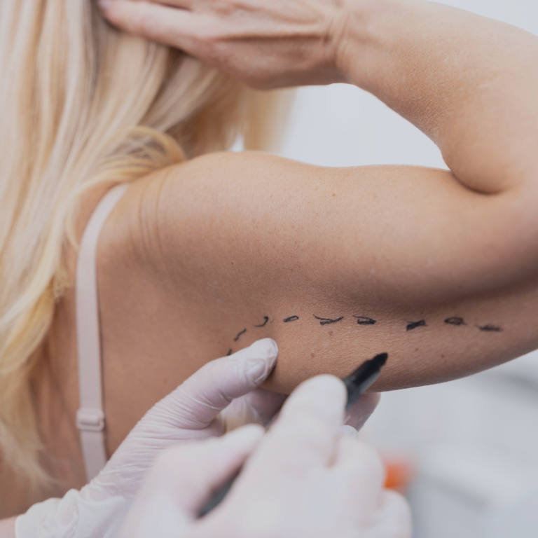 Lifting des bras ou Brachioplastie aux Sables d'Olonne